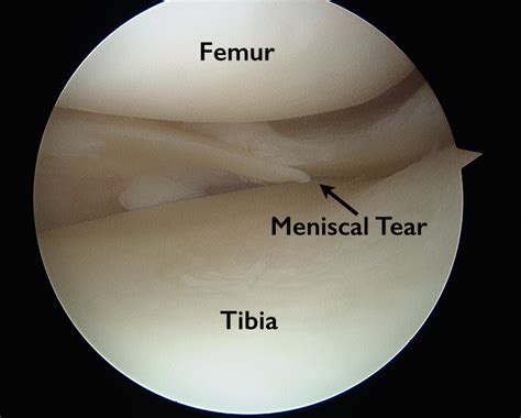 torn meniscus anatomy